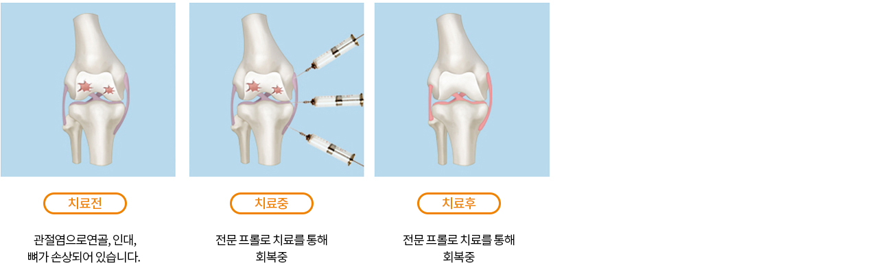 비수술치료 안내 이미지 2