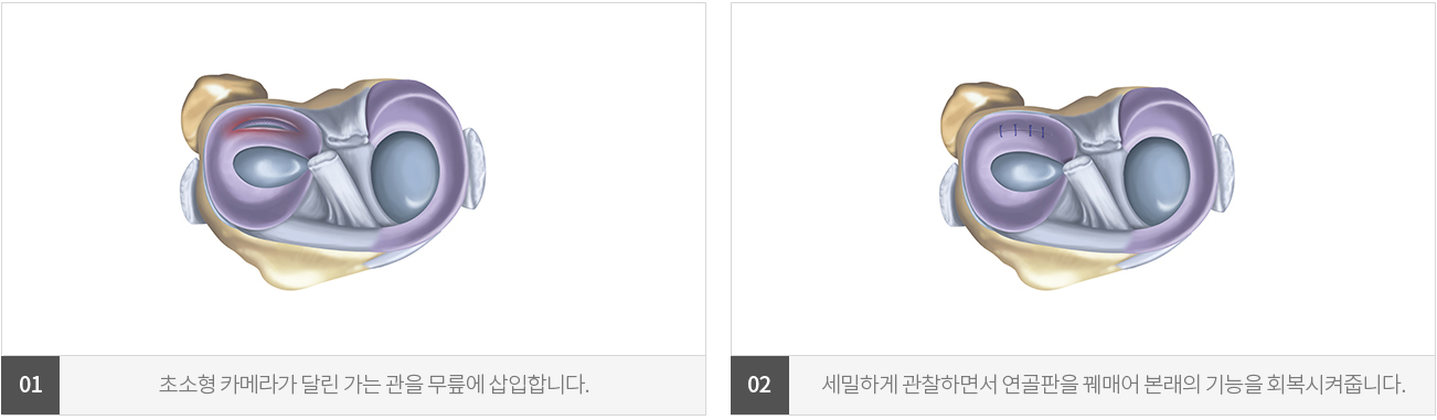 수술치료 안내 이미지 1