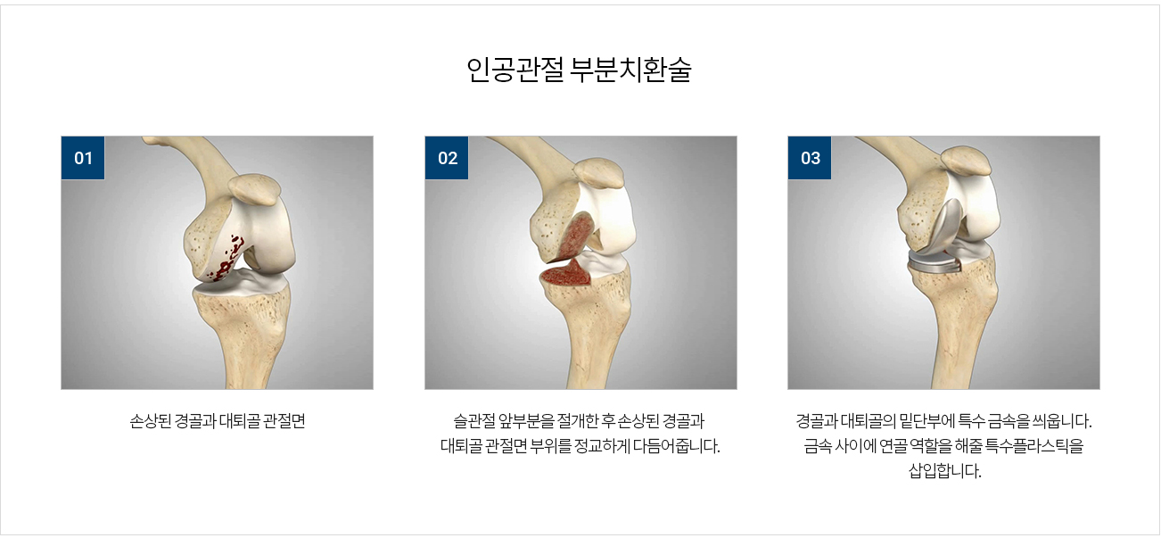 수술치료 안내 이미지 2