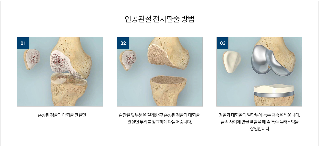 수술치료 안내 이미지 1