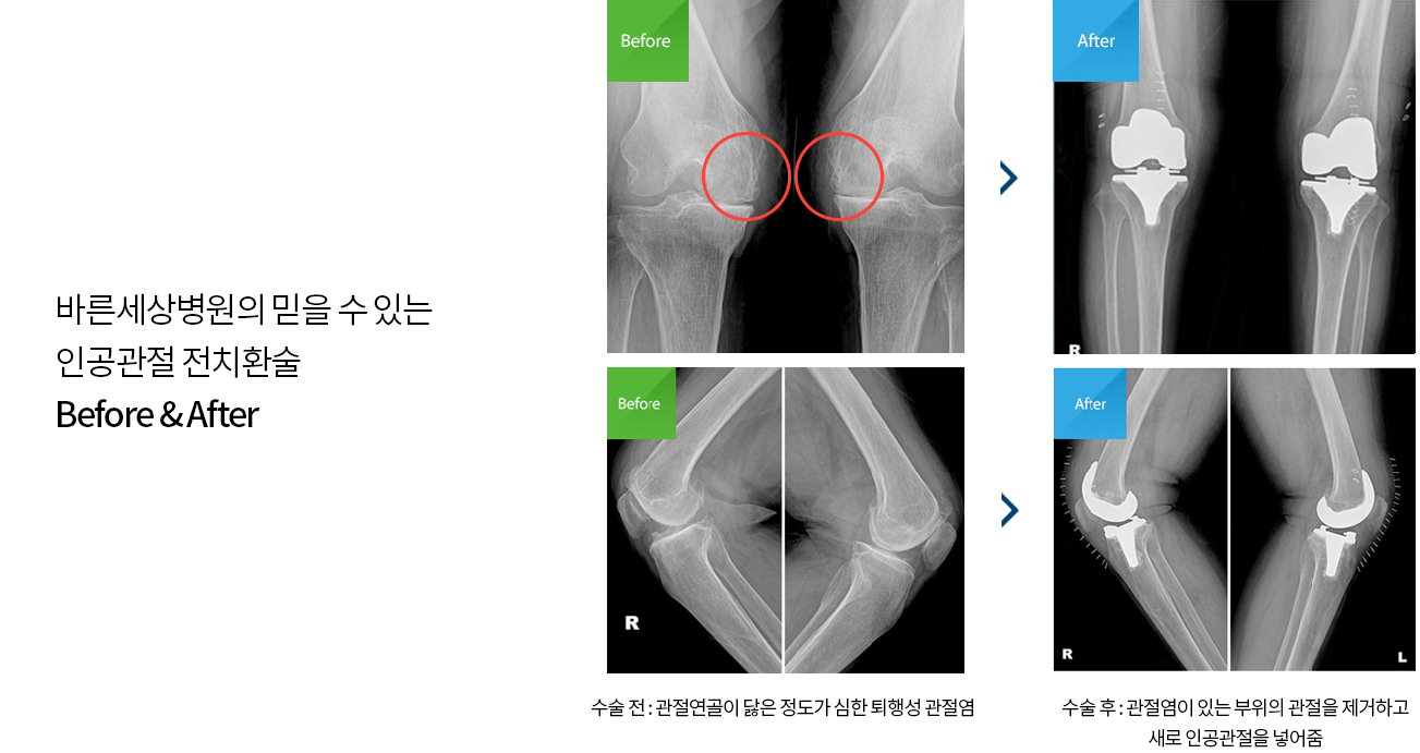 수술치료 안내 이미지 3