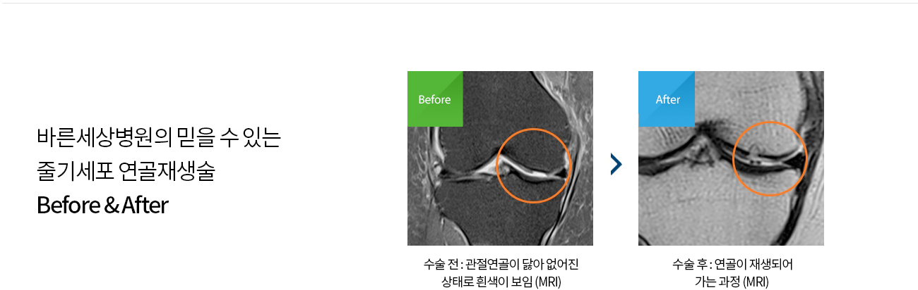 수술치료 안내 이미지 1