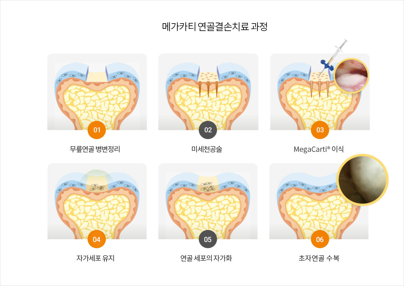 메가카티 연골결손치료 과정